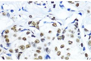 Immunohistochemistry of paraffin-embedded Human mammary cancer using TriMethyl-Histone H3-K79 Polyclonal Antibody at dilution of 1:200 (40x lens). (Histone 3 antibody  (3meLys79))
