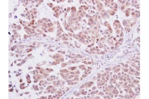 IHC-P Image DNA polymerase delta antibody detects DNA polymerase delta protein at cytoplasm and nucleus on human lung adenocarcinoma by immunohistochemical analysis. (POLD1 antibody  (Center))