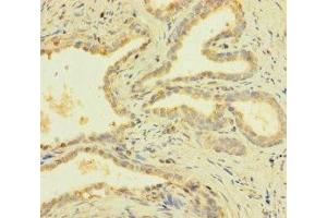 Immunohistochemistry of paraffin-embedded human prostate cancer using ABIN7166618 at dilution of 1:100 (PRY antibody  (AA 13-147))