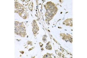 Immunohistochemistry of paraffin-embedded human gastric cancer using SBDS antibody (ABIN5973483) at dilution of 1/100 (40x lens). (SBDS antibody)