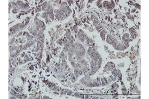 Immunoperoxidase of monoclonal antibody to FOXO3A on formalin-fixed paraffin-embedded human colon adenocarcinoma. (FOXO3 antibody  (AA 361-460))