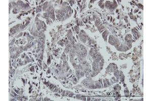 Immunoperoxidase of monoclonal antibody to FOXO3A on formalin-fixed paraffin-embedded human colon adenocarcinoma.