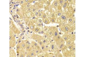 Immunohistochemistry of paraffin-embedded Human liver damage using TRAF3IP2 Polyclonal Antibody at dilution of 1:100 (40x lens). (TRAF3IP2 antibody)