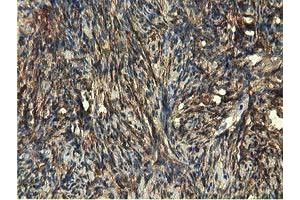 Immunohistochemical staining of paraffin-embedded Carcinoma of Human kidney tissue using anti-EPHX2 mouse monoclonal antibody. (EPHX2 antibody)