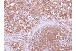 IHC-P Image Immunohistochemical analysis of paraffin-embedded human lung SCC, using ARHGAP1, antibody at 1:100 dilution. (ARHGAP1 antibody)