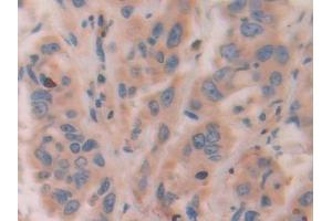 Detection of ATF4 in Human Breast cancer Tissue using Polyclonal Antibody to Activating Transcription Factor 4 (ATF4) (ATF4 antibody  (AA 130-347))