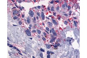 Anti-GPR56 antibody IHC of human Skin, Melanoma. (GPR56 antibody  (Cytoplasmic Domain))