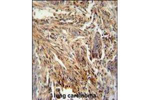 CSF2 antibody immunohistochemistry analysis in formalin fixed and paraffin embedded human lung carcinoma followed by peroxidase conjugation of the secondary antibody and DAB staining. (GM-CSF antibody  (AA 59-85))