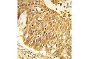 Formalin-fixed and paraffin-embedded human lung carcinoma reacted with  EEFSEC / SELB Antibody (C-term) followed which was peroxidase-conjugated to the secondary antibody, followed by DAB staining. (EEFSEC antibody  (C-Term))