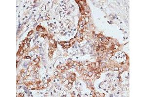 Immunohistochemistry of paraffin-embedded Human liver cancer using PIGR Polyclonal Antibody at dilution of 1:100 (40x lens). (PIGR antibody)