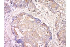Paraformaldehyde-fixed, paraffin embedded human colon cancer, Antigen retrieval by boiling in sodium citrate buffer (pH6) for 15min, Block endogenous peroxidase by 3% hydrogen peroxide for 30 minutes, Blocking buffer (normal goat serum) at 37°C for 20min, Antibody incubation with Rabbit Anti-LRRC19 Polyclonal Antibody, Unconjugated  at 1:200 overnight at 4°C, followed by a conjugated secondary and DAB staining. (LRRC19 antibody  (AA 41-140))