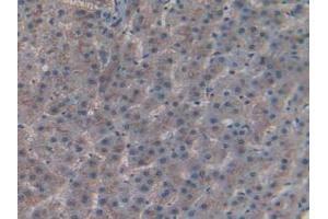IHC-P analysis of Human Liver Cancer Tissue, with DAB staining. (CD55 antibody  (AA 35-285))