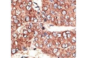 IHC analysis of FFPE human hepatocarcinoma tissue stained with the Megalin antibody (LRP2 antibody  (AA 4626-4655))