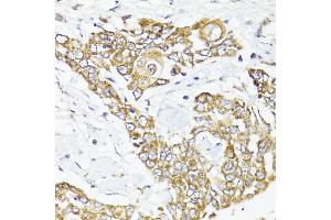 Immunohistochemistry of paraffin-embedded human colon carcinoma using MAVS antibody (ABIN6132297, ABIN6143583, ABIN6143584 and ABIN6221441) at dilution of 1:100 (40x lens).