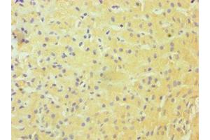 Immunohistochemistry of paraffin-embedded human liver cancer using ABIN7144985 at dilution of 1:100 (DDX3X antibody  (AA 1-220))