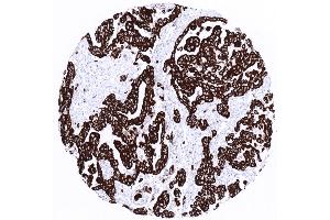 Malignant mesothelioma with strong cytokeratin 19 positivity (Cytokeratin 19 antibody)