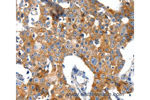Immunohistochemistry of Human gastic cancer using GRIA2 Polyclonal Antibody at dilution of 1:40 (GRIA2 antibody)