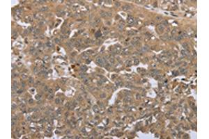 The image on the left is immunohistochemistry of paraffin-embedded Human ovarian cancer tissue using ABIN7192692(STMN2/STMN3/STMN4 Antibody) at dilution 1/45, on the right is treated with synthetic peptide. (STMN2/STMN3/STMN4 antibody)