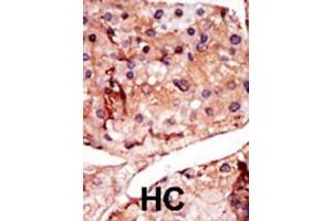 Formalin-fixed and paraffin-embedded human cancer tissue reacted with the primary antibody, which was peroxidase-conjugated to the secondary antibody, followed by DAB staining. (PFKFB2 antibody  (N-Term))