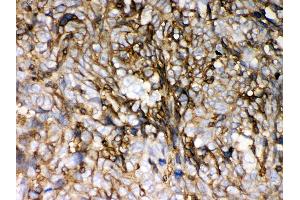 Anti- HLA-C Picoband antibody,IHC(P) IHC(P): Human Lung Cancer Tissue (HLA-C antibody  (C-Term))