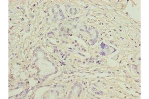 Immunohistochemistry of paraffin-embedded human pancreatic cancer using ABIN7158038 at dilution of 1:100 (LRG1 antibody  (AA 36-346))