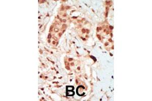 Formalin-fixed and paraffin-embedded human cancer tissue reacted with PFTK2 polyclonal antibody  , which was peroxidase-conjugated to the secondary antibody, followed by DAB staining.