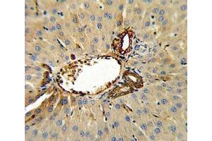 Annexin V antibody IHC analysis in formalin fixed and paraffin embedded human hepatocarcinoma. (Annexin V antibody  (AA 262-291))