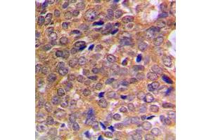 Immunohistochemical analysis of ABL1/2 (pY393/439) staining in human breast cancer formalin fixed paraffin embedded tissue section. (ABL1/2 antibody  (C-Term, pTyr393, pTyr439))