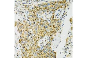 Immunohistochemistry of paraffin-embedded human lung cancer using HSPA9 antibody. (HSPA9 antibody  (AA 380-679))