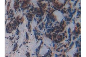 Detection of MPG in Human Breast cancer Tissue using Polyclonal Antibody to N-Methylpurine DNA Glycosylase (MPG) (MPG antibody  (AA 221-296))
