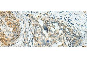 Immunohistochemistry of paraffin-embedded Human cervical cancer tissue using PLPPR5 Polyclonal Antibody at dilution of 1:120(x200) (LPPR5 antibody)