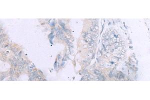 Immunohistochemistry of paraffin-embedded Human colorectal cancer tissue using GPC3 Polyclonal Antibody at dilution of 1:60(x200) (Glypican 3 antibody)