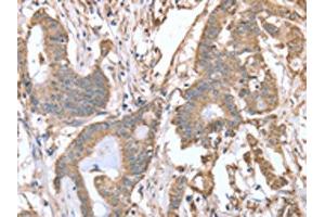 The image on the left is immunohistochemistry of paraffin-embedded Human colon cancer tissue using ABIN7128119(ABCB6 Antibody) at dilution 1/15, on the right is treated with fusion protein.