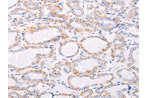 The image on the left is immunohistochemistry of paraffin-embedded Human thyroid cancer tissue using ABIN7189808(ANKRD26 Antibody) at dilution 1/25, on the right is treated with synthetic peptide. (ANKRD26 antibody)