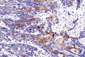 Immunohistochemistry analysis of paraffin-embedded human esophageal cancer using MIIP (ABIN7074626) at dilution of 1: 1200 (MIIP antibody)