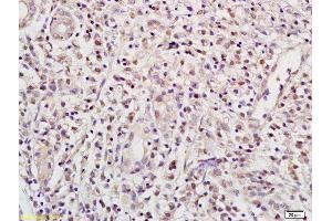 Formalin-fixed and paraffin embedded human gastric carcinoma labeled with Anti RBPJK/RBP-J Polyclonal Antibody, Unconjugated (ABIN872972) at 1:200 followed by conjugation to the secondary antibody and DAB staining (RBPJ antibody  (AA 101-200))
