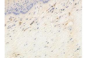 ABIN6263940 and ABIN6266908 at 1/100 staining human cervical carcinoma by IHC-P. (CDKN2C antibody  (C-Term))
