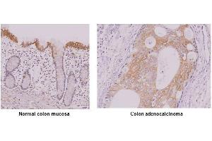 Paraffin embedded sections of normal colon mucosa and colon adenocalcinoma tissue were incubated with anti-human IRF-5 antibody (1:50) for 2 hours at room temperature. (IRF5 antibody  (AA 176-240))