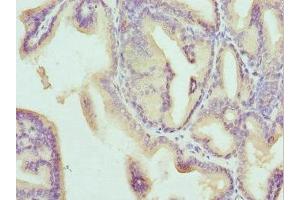 Immunohistochemistry of paraffin-embedded human prostate cancer using ABIN7171371 at dilution of 1:100 (CD1b antibody  (AA 18-303))