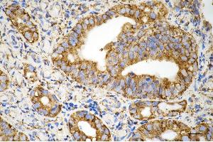 Immunohistochemistry was performed on paraffin-embedded human sigmoid colon carcinoma using prolyl 4-hydroxylase subunit beta antibody (ABIN7799920), 1:200). (Recombinant P4HB antibody)