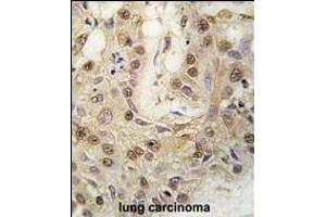 Formalin-fixed and paraffin-embedded human lung carcinoma tissue reacted with cGKII antibody (C-term) (ABIN392537 and ABIN2842089) , which was peroxidase-conjugated to the secondary antibody, followed by DAB staining. (PRKG2 antibody  (C-Term))