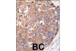 Formalin-fixed and paraffin-embedded human breast carcinoma tissue reacted with PLK2 polyclonal antibody  , which was peroxidase-conjugated to the secondary antibody, followed by DAB staining. (PLK2 antibody  (C-Term))