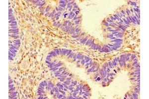 Immunohistochemistry of paraffin-embedded human ovarian cancer using ABIN7142675 at dilution of 1:100 (PRKAA1 antibody  (Catalytic Subunit alpha))