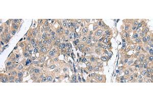 Immunohistochemistry of paraffin-embedded Human liver cancer tissue using CLEC1B Polyclonal Antibody at dilution of 1:60(x200) (C-Type Lectin Domain Family 1, Member B (CLEC1B) antibody)