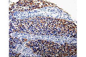 Immunohistochemistry of Human renal cancer using COX10 Polyclonal Antibody at dilution of 1:100 (COX10 antibody)