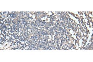 Immunohistochemistry of paraffin-embedded Human tonsil tissue using UBASH3A Polyclonal Antibody at dilution of 1:50(x200) (UBASH3A antibody)