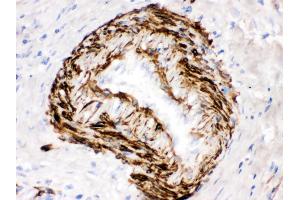 SMYD3 was detected in paraffin-embedded sections of human intestinal cancer tissues using rabbit anti- SMYD3 Antigen Affinity purified polyclonal antibody at 1 μg/mL. (SMYD3 antibody  (C-Term))