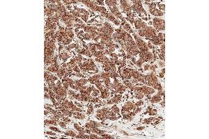 Immunohistochemical analysis of paraffin-embedded human breast carcinoma tissue using (ABIN6242215 and ABIN6577457) performed on the Leica® BOND RXm. (Cathepsin D antibody  (AA 1-412))