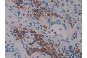 Detection of LAT2 in Human Lung cancer Tissue using Polyclonal Antibody to Linker For Activation Of T-Cells Family, Member 2 (LAT2) (LAT2 antibody  (AA 30-209))