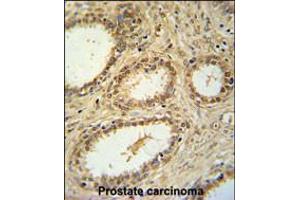 SNRNP40 Antibody immunohistochemistry analysis in formalin fixed and paraffin embedded human prostate carcinoma followed by peroxidase conjugation of the secondary antibody and DAB staining.
